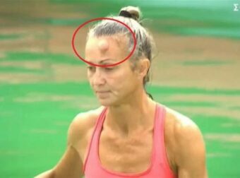 Survivor spoiler 27/2: Στο νοσοκομείο εκτάκτως η Δώρα Νικολή – Το εξόγκωμα στο κεφάλι και οι φήμες για αποχώρηση