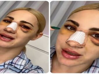 Τρομάζει η εικόνα της Τούνη μετά την πλαστική