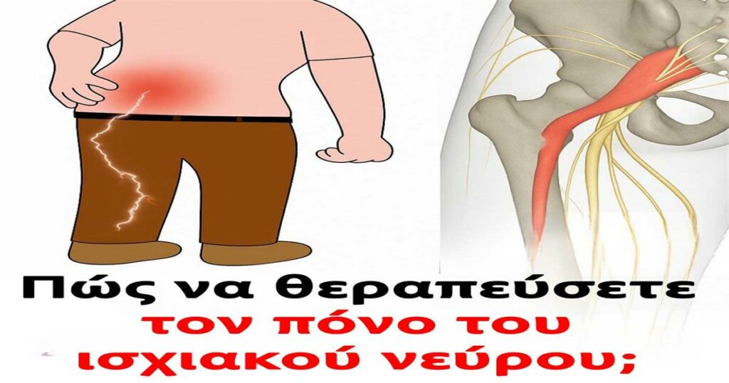 “Απαλλαγείτε από τον ισχιαλγικό πόνο: 3 ασκήσεις για άμεση ανακούφιση και ευεξία.”