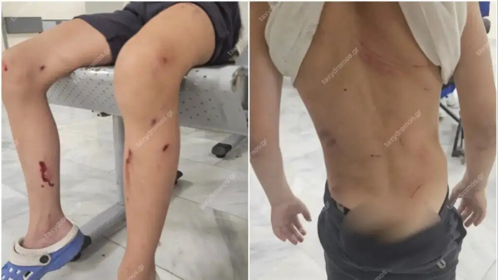 7χρονο αγόρι στο νοσοκομείο μετά από άγρια επίθεση σκύλων – Συγκλονίζει η περιγραφή της μητέρας του: «Παραλίγο να το κατασπαράξουν»