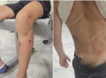 7χρονο αγόρι στο νοσοκομείο μετά από άγρια επίθεση σκύλων – Συγκλονίζει η περιγραφή της μητέρας του: «Παραλίγο να το κατασπαράξουν»