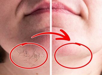 Απαλλαγείτε από τις ανεπιθύμητες τρίχες στο πρόσωπο με φυσικό τρόπο: Η απόλυτη σπιτική συνταγή για αποτελέσματα που ξεχωρίζουν!