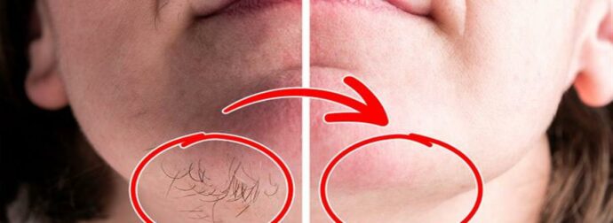 Απαλλαγείτε από τις ανεπιθύμητες τρίχες στο πρόσωπο με φυσικό τρόπο: Η απόλυτη σπιτική συνταγή για αποτελέσματα που ξεχωρίζουν!