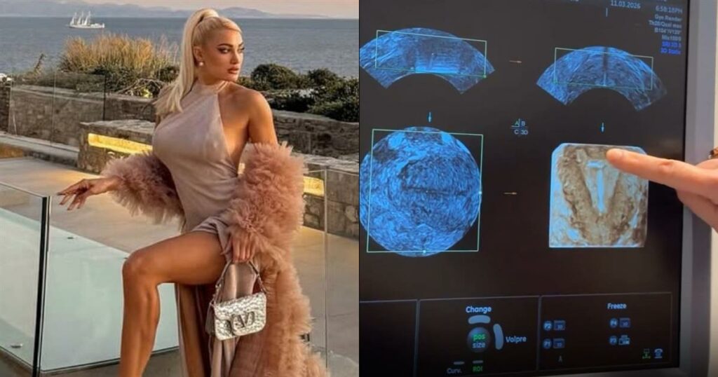 Ιωάννα Τούνη: Ο υπέρηχος που προκάλεσε συζητήσεις – Η απάντησή της στις φήμες εγκυμοσύνης.