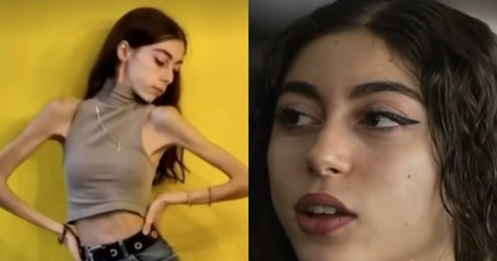 Συγκλονιστική μαρτυρία για τη νευρική ανορεξία στον Σρόιτερ: «Στα 31 κιλά και πάλι ένιωθα παχιά» – Η αποκαλυπτική αυτοψία!