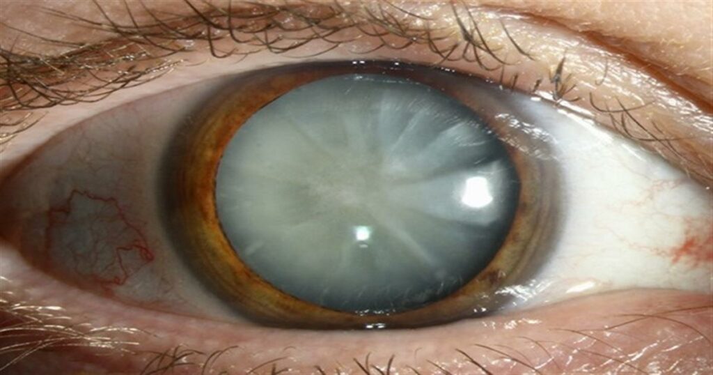 «Καταρράκτης: Ανακαλύψτε τα Πρώτα Σημάδια, τις Σύγχρονες Θεραπείες και τη Διαδικασία Ανάκαμψης»