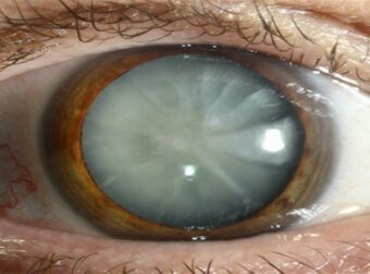 «Καταρράκτης: Ανακαλύψτε τα Πρώτα Σημάδια, τις Σύγχρονες Θεραπείες και τη Διαδικασία Ανάκαμψης»